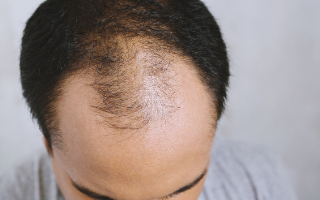 Close up of a guys head with reciding hairline